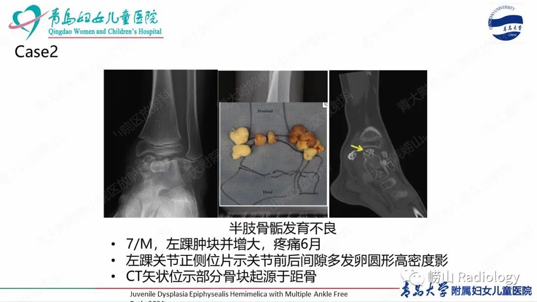影像PPT - 【病例】半肢骨骺发育不良1例X线CT及MR-16
