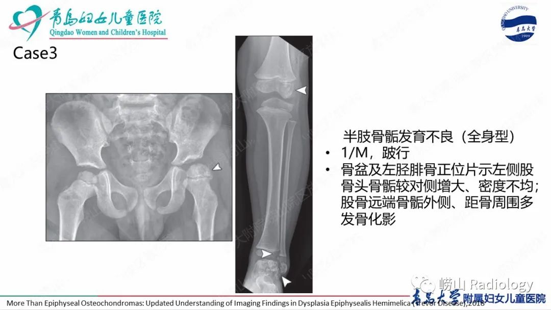 影像PPT - 【病例】半肢骨骺发育不良1例X线CT及MR-18