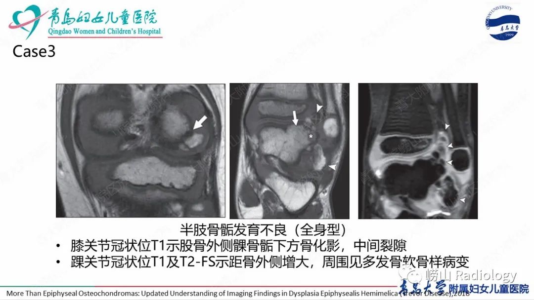 影像PPT - 【病例】半肢骨骺发育不良1例X线CT及MR-19