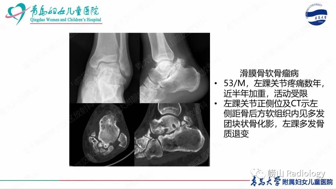 影像PPT - 【病例】半肢骨骺发育不良1例X线CT及MR-22