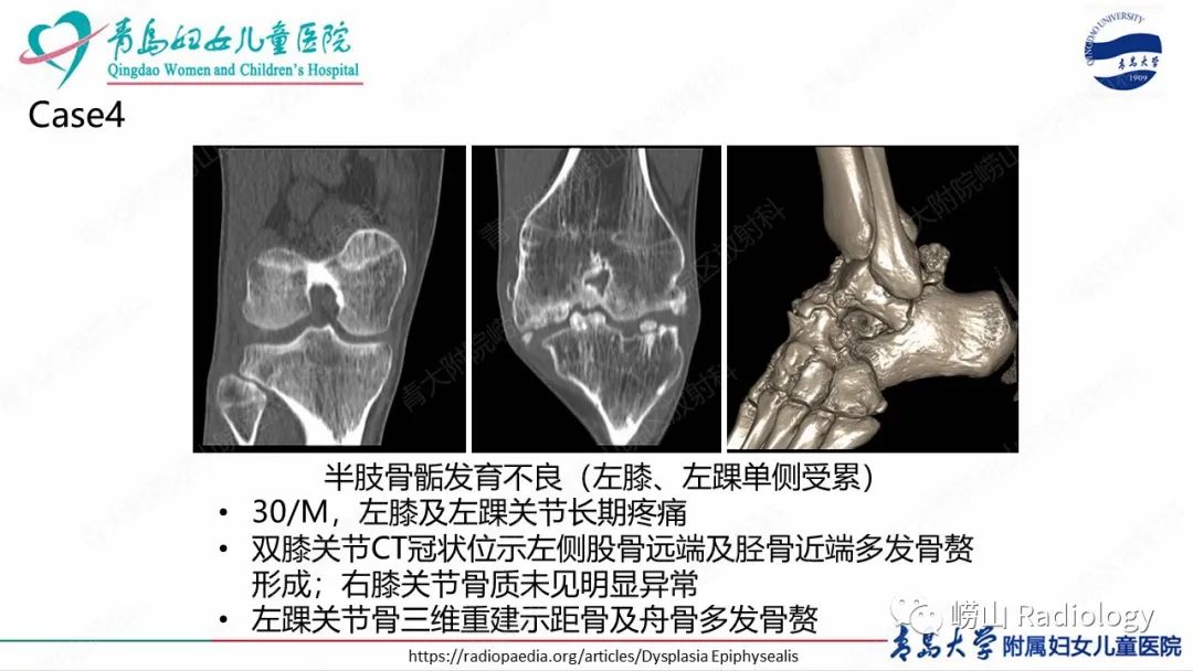 影像PPT - 【病例】半肢骨骺发育不良1例X线CT及MR-20