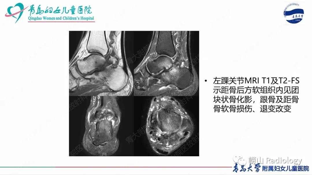 影像PPT - 【病例】半肢骨骺发育不良1例X线CT及MR-23