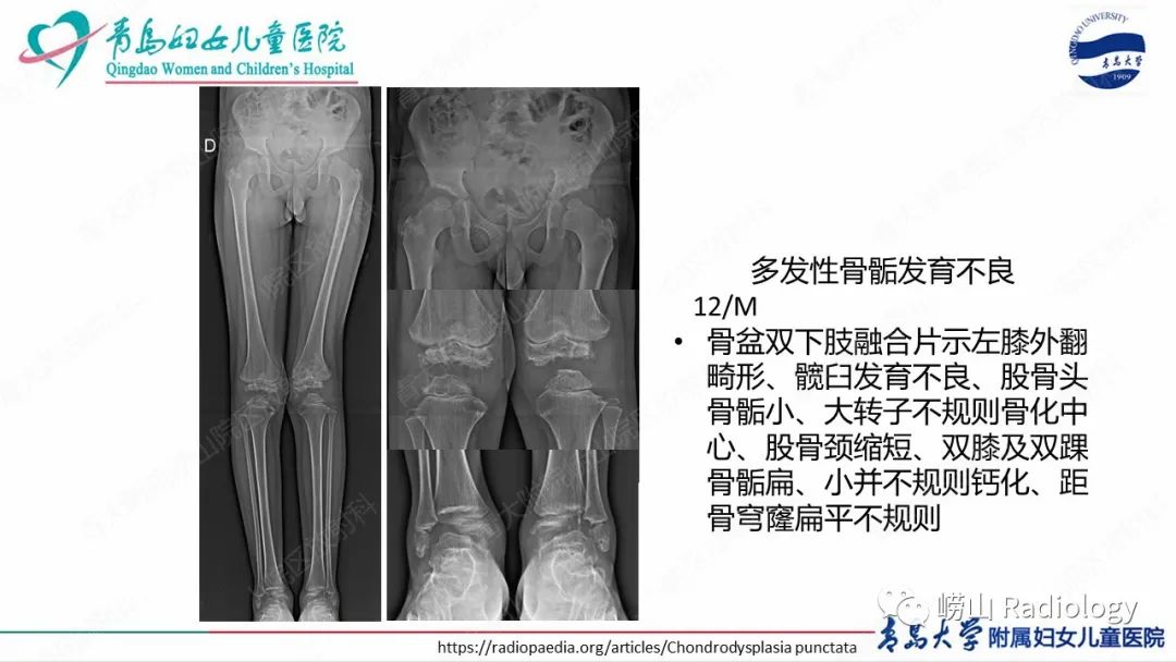 影像PPT - 【病例】半肢骨骺发育不良1例X线CT及MR-26