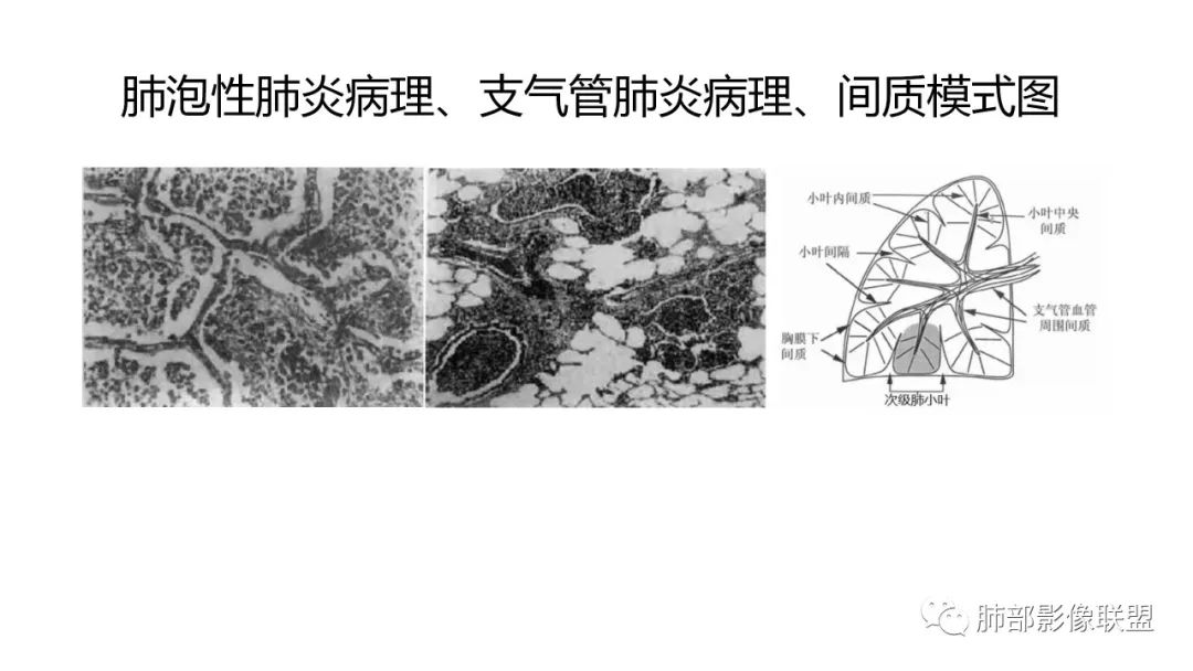影像PPT - 【PPT】肺炎影像的三个基础问题-4 影像PPT - 【PPT】肺炎影像的三个基础问题-4