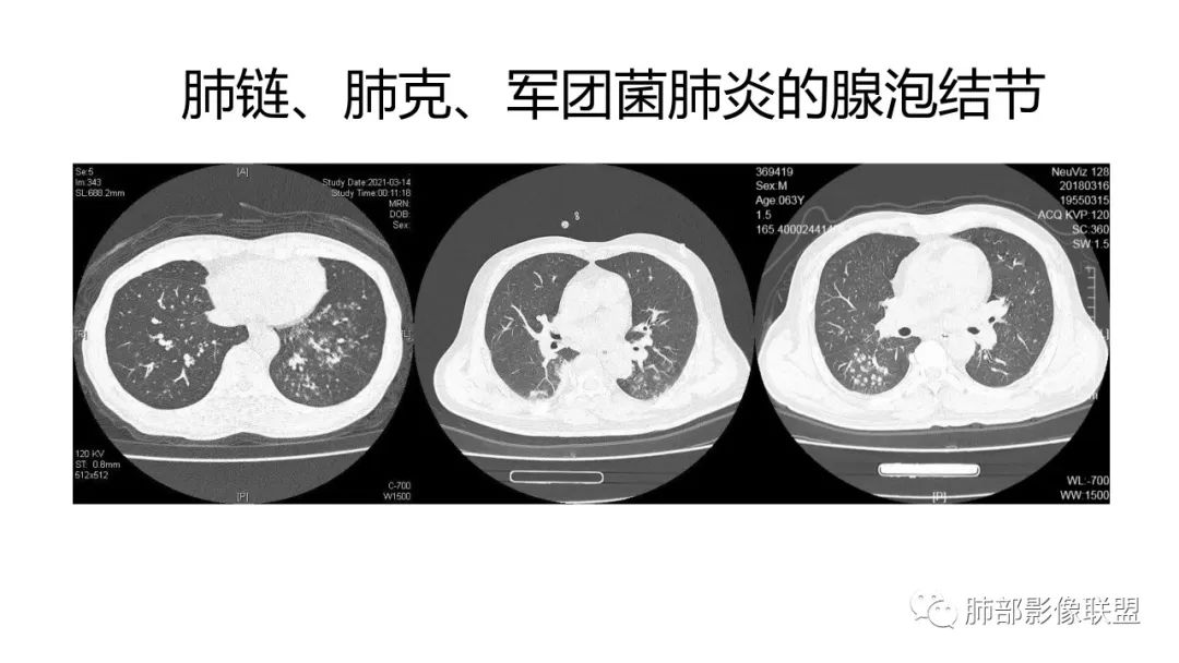 影像PPT - 【PPT】肺炎影像的三个基础问题-6 影像PPT - 【PPT】肺炎影像的三个基础问题-6