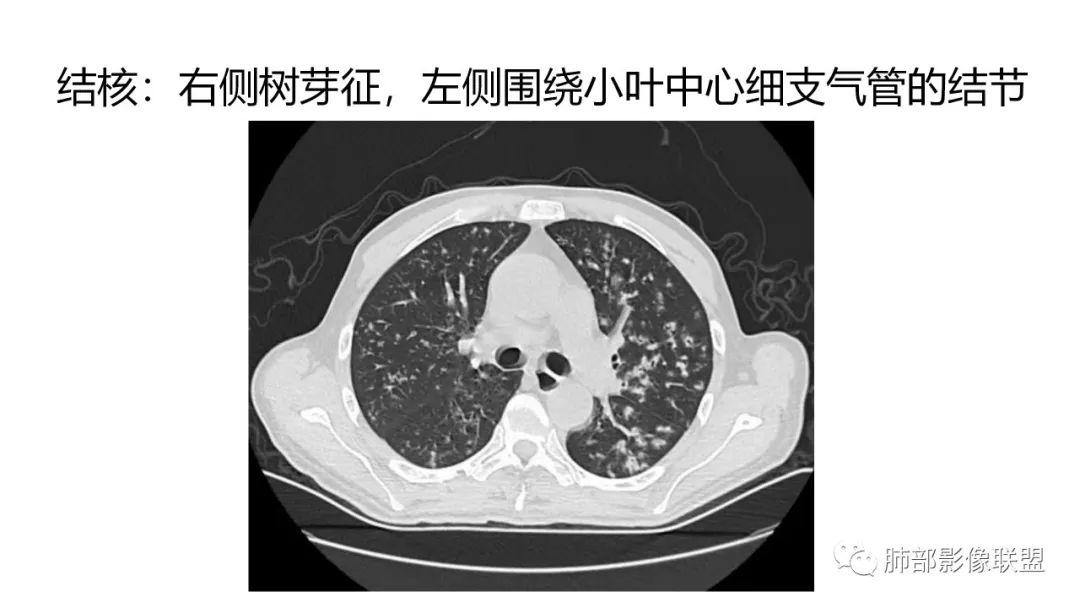 影像PPT - 【PPT】肺炎影像的三个基础问题-8 影像PPT - 【PPT】肺炎影像的三个基础问题-8