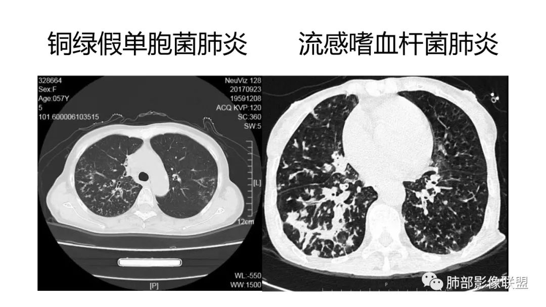 影像PPT - 【PPT】肺炎影像的三个基础问题-9 影像PPT - 【PPT】肺炎影像的三个基础问题-9