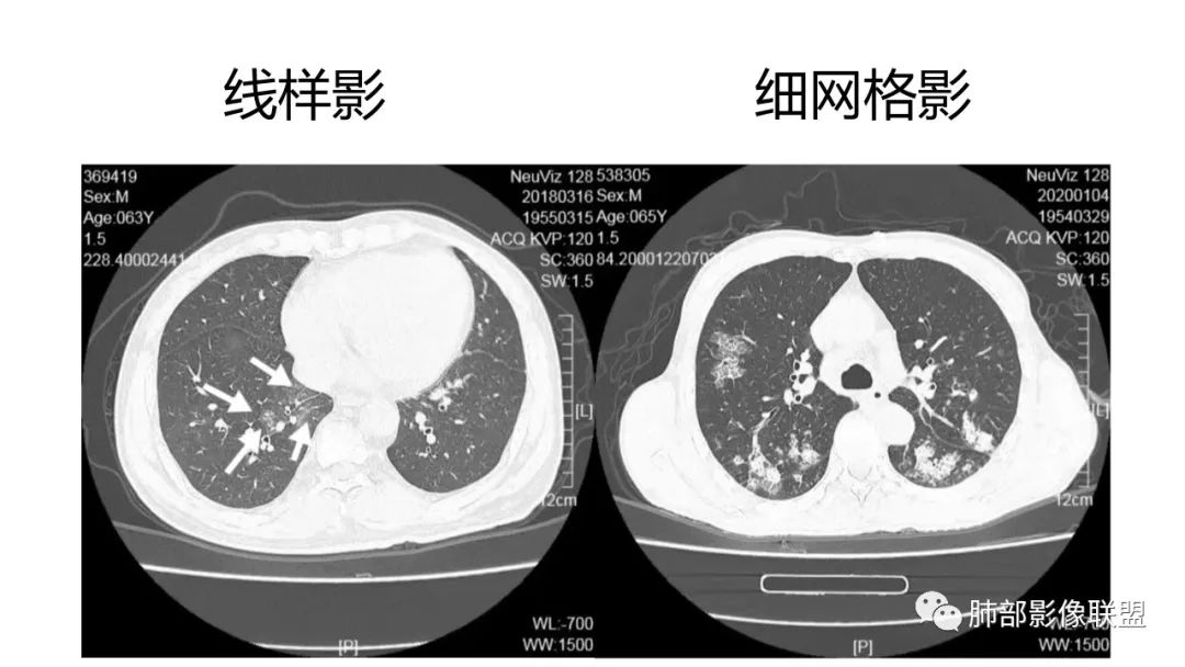 影像PPT - 【PPT】肺炎影像的三个基础问题-12 影像PPT - 【PPT】肺炎影像的三个基础问题-12