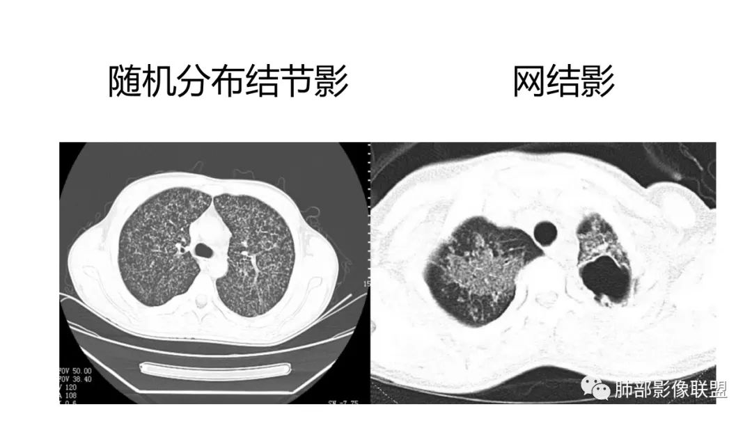 影像PPT - 【PPT】肺炎影像的三个基础问题-13 影像PPT - 【PPT】肺炎影像的三个基础问题-13