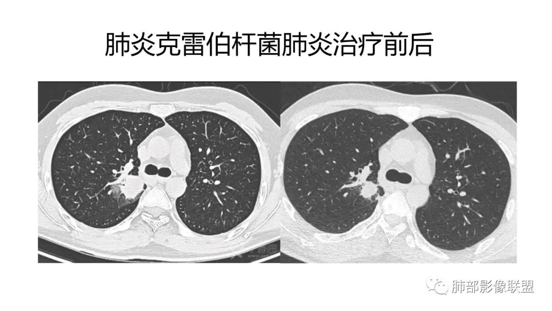影像PPT - 【PPT】肺炎影像的三个基础问题-15 影像PPT - 【PPT】肺炎影像的三个基础问题-15