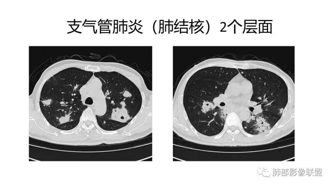 影像PPT - 【PPT】肺炎影像的三个基础问题-16 影像PPT - 【PPT】肺炎影像的三个基础问题-16