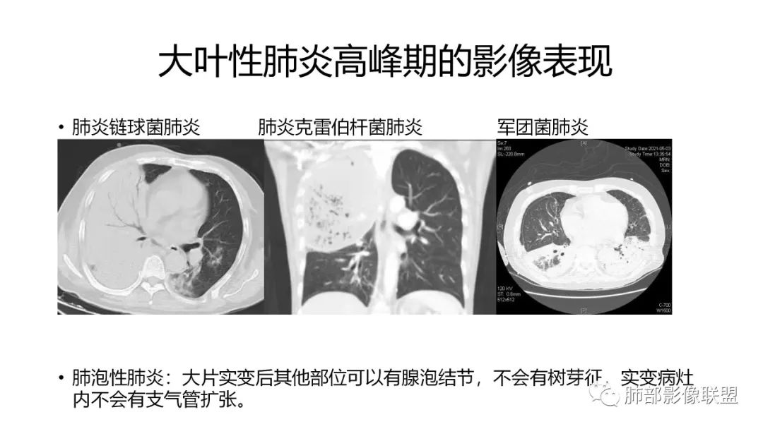 影像PPT - 【PPT】肺炎影像的三个基础问题-18 影像PPT - 【PPT】肺炎影像的三个基础问题-18