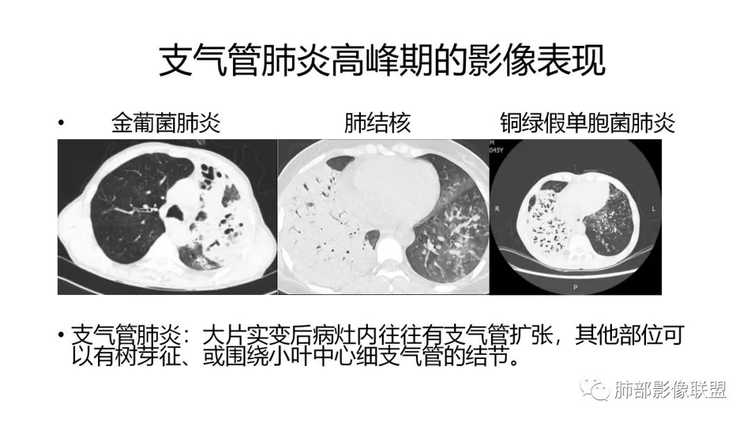 影像PPT - 【PPT】肺炎影像的三个基础问题-19 影像PPT - 【PPT】肺炎影像的三个基础问题-19