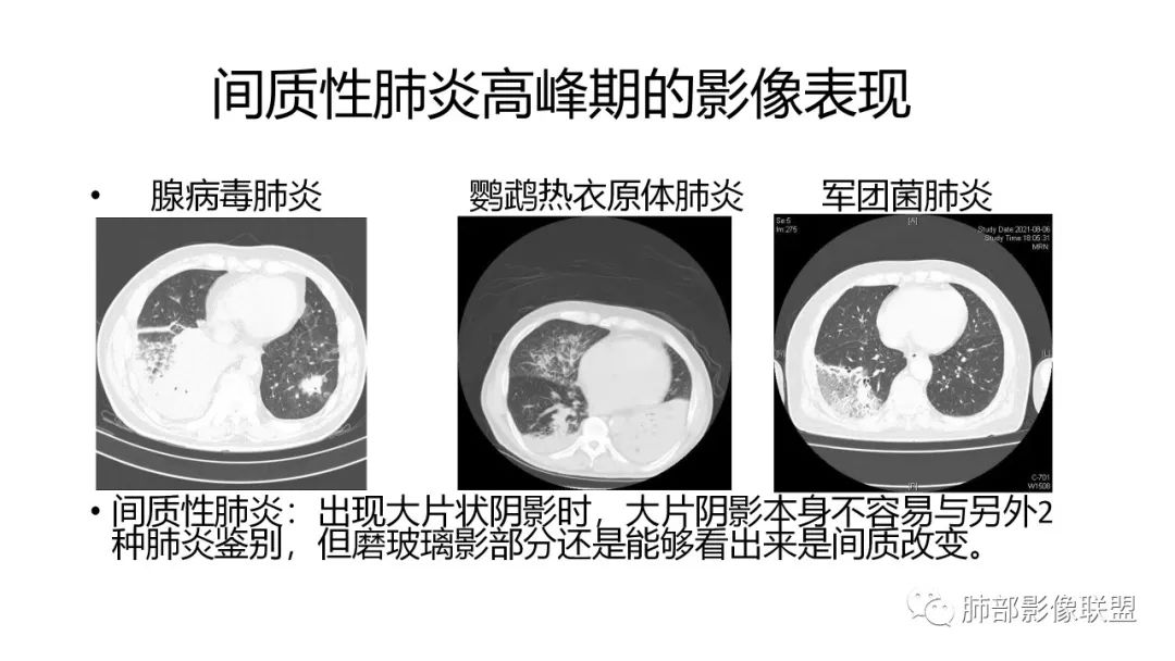 影像PPT - 【PPT】肺炎影像的三个基础问题-20 影像PPT - 【PPT】肺炎影像的三个基础问题-20