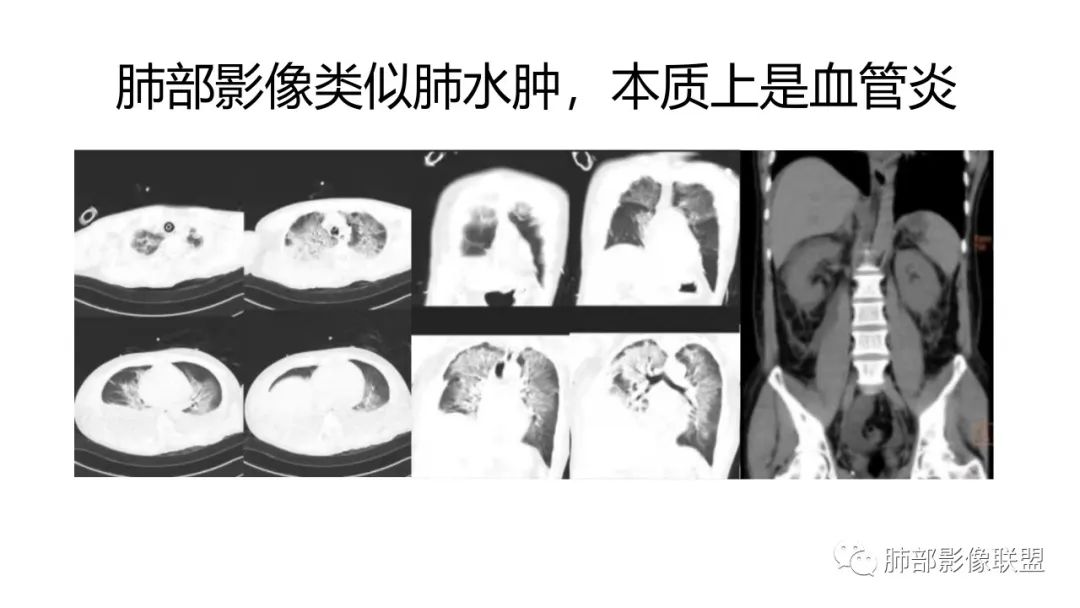 影像PPT - 【PPT】肺炎影像的三个基础问题-29 影像PPT - 【PPT】肺炎影像的三个基础问题-29