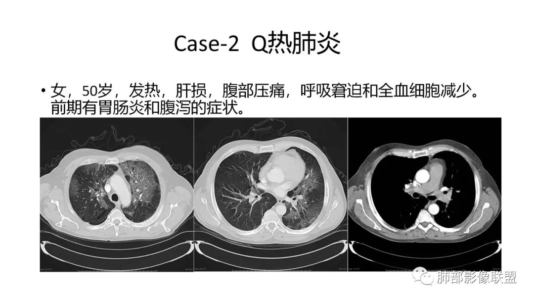 影像PPT - 【PPT】肺炎影像的三个基础问题-30 影像PPT - 【PPT】肺炎影像的三个基础问题-30