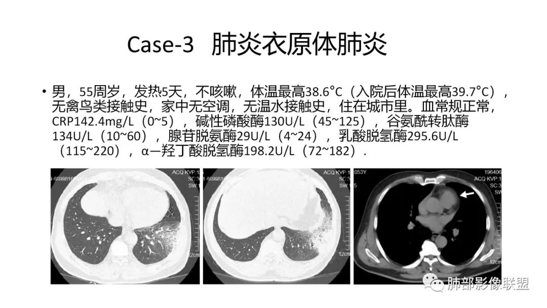 影像PPT - 【PPT】肺炎影像的三个基础问题-31 影像PPT - 【PPT】肺炎影像的三个基础问题-31