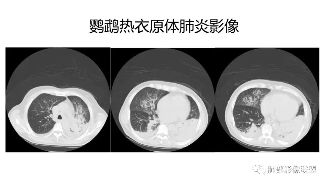 影像PPT - 【PPT】肺炎影像的三个基础问题-33 影像PPT - 【PPT】肺炎影像的三个基础问题-33
