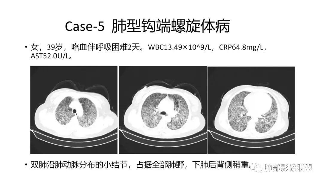 影像PPT - 【PPT】肺炎影像的三个基础问题-34 影像PPT - 【PPT】肺炎影像的三个基础问题-34