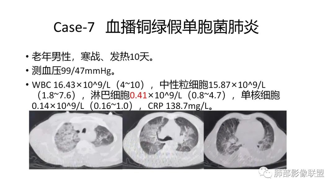 影像PPT - 【PPT】肺炎影像的三个基础问题-37 影像PPT - 【PPT】肺炎影像的三个基础问题-37