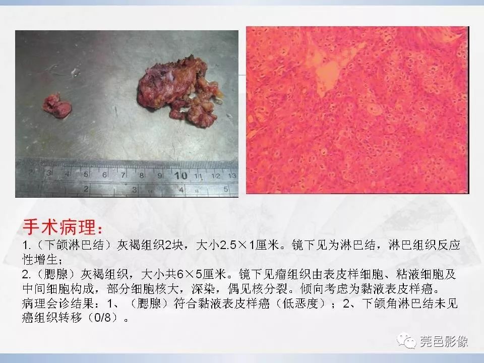 影像PPT - 【PPT】腮腺粘液表皮样癌的CT诊断与鉴别-13