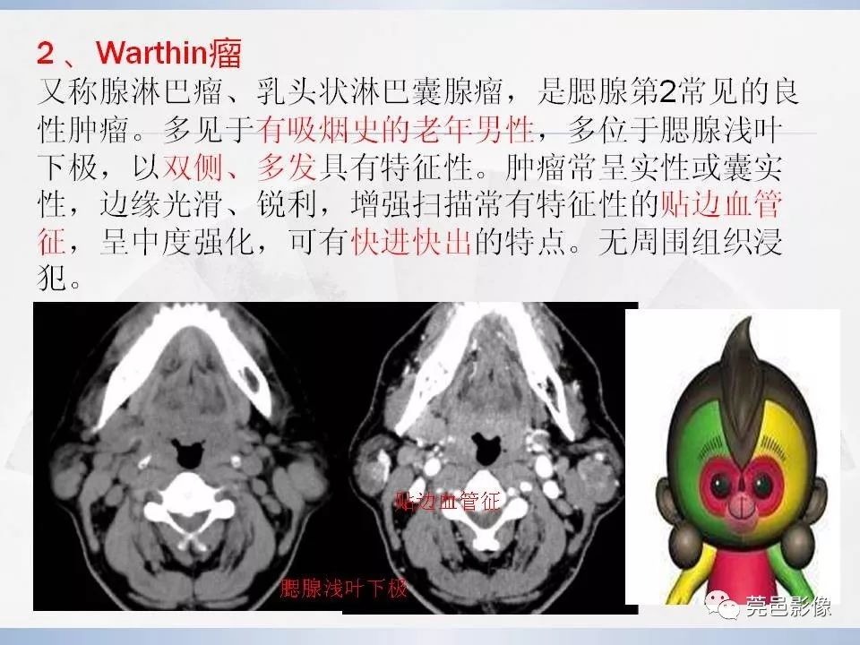 影像PPT - 【PPT】腮腺粘液表皮样癌的CT诊断与鉴别-20