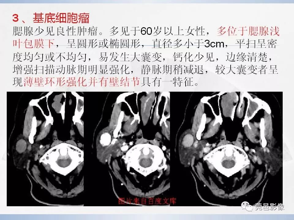 影像PPT - 【PPT】腮腺粘液表皮样癌的CT诊断与鉴别-21