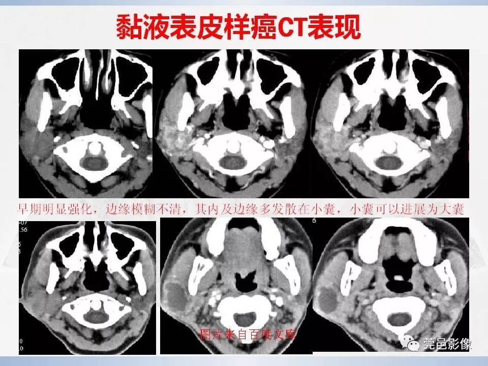 影像PPT - 【PPT】腮腺粘液表皮样癌的CT诊断与鉴别-18
