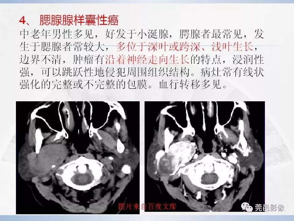 影像PPT - 【PPT】腮腺粘液表皮样癌的CT诊断与鉴别-22