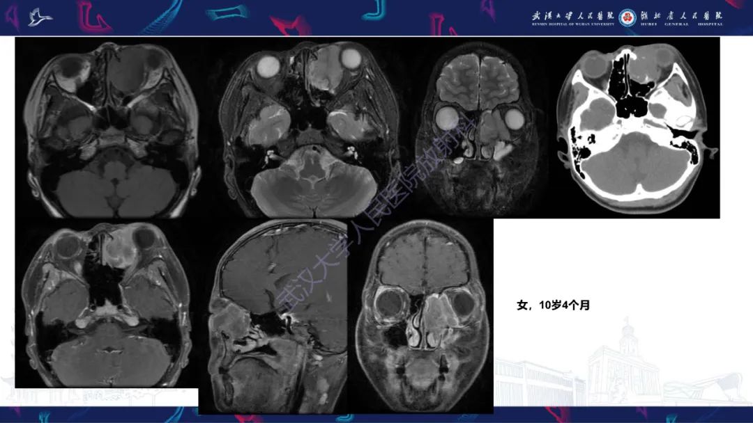 影像PPT - 【PPT】儿童眼眶肿瘤及肿瘤样病变影像诊断-3