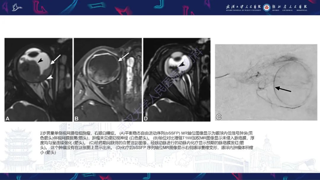 影像PPT - 【PPT】儿童眼眶肿瘤及肿瘤样病变影像诊断-10