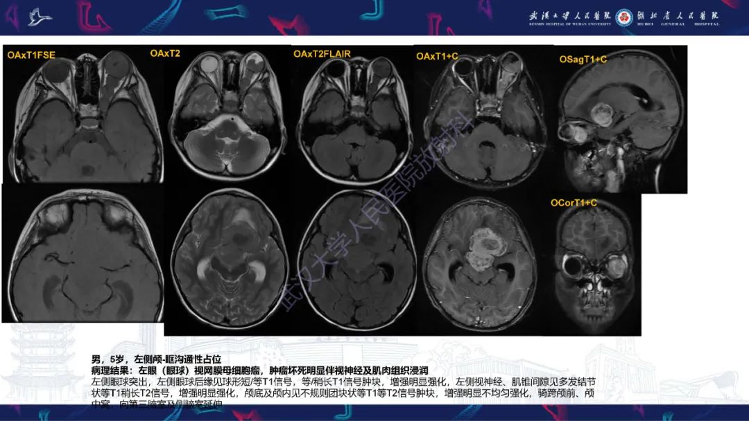 影像PPT - 【PPT】儿童眼眶肿瘤及肿瘤样病变影像诊断-11