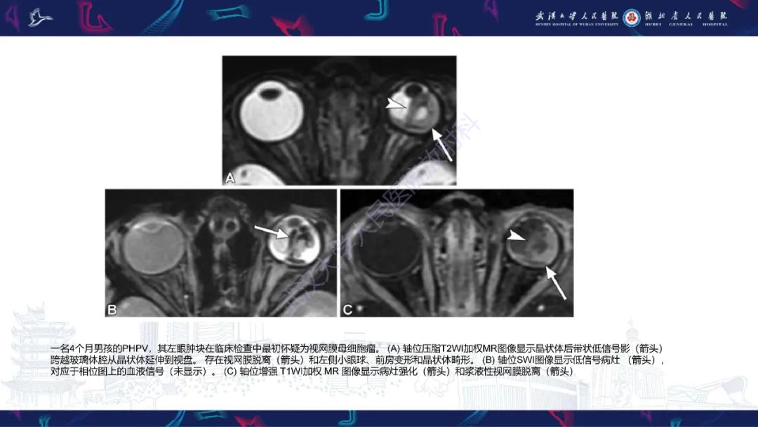 影像PPT - 【PPT】儿童眼眶肿瘤及肿瘤样病变影像诊断-14