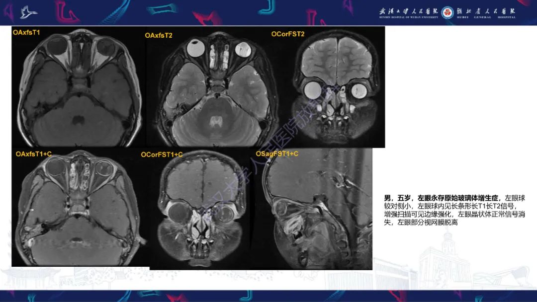 影像PPT - 【PPT】儿童眼眶肿瘤及肿瘤样病变影像诊断-16