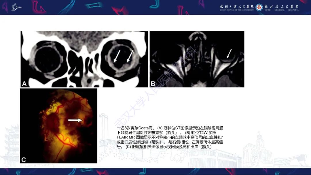 影像PPT - 【PPT】儿童眼眶肿瘤及肿瘤样病变影像诊断-18