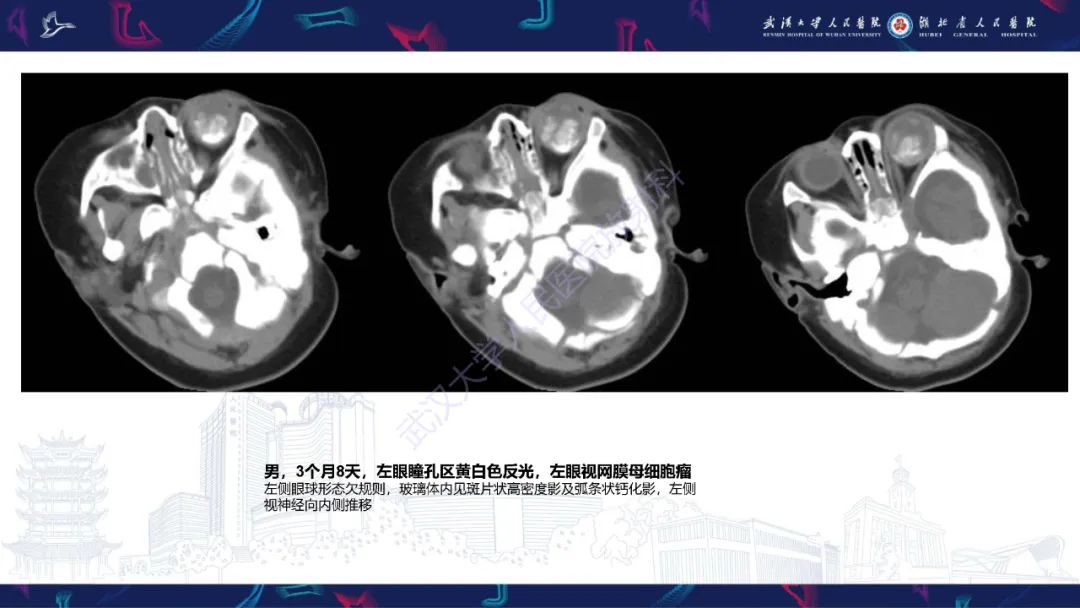 影像PPT - 【PPT】儿童眼眶肿瘤及肿瘤样病变影像诊断-12
