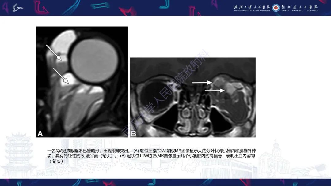 影像PPT - 【PPT】儿童眼眶肿瘤及肿瘤样病变影像诊断-21