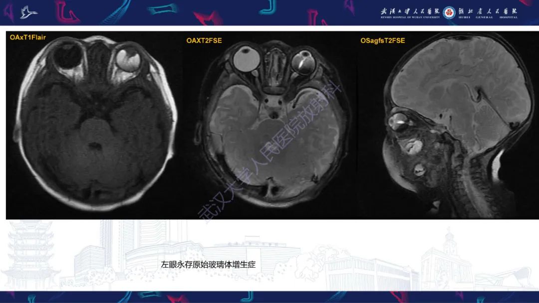 影像PPT - 【PPT】儿童眼眶肿瘤及肿瘤样病变影像诊断-15