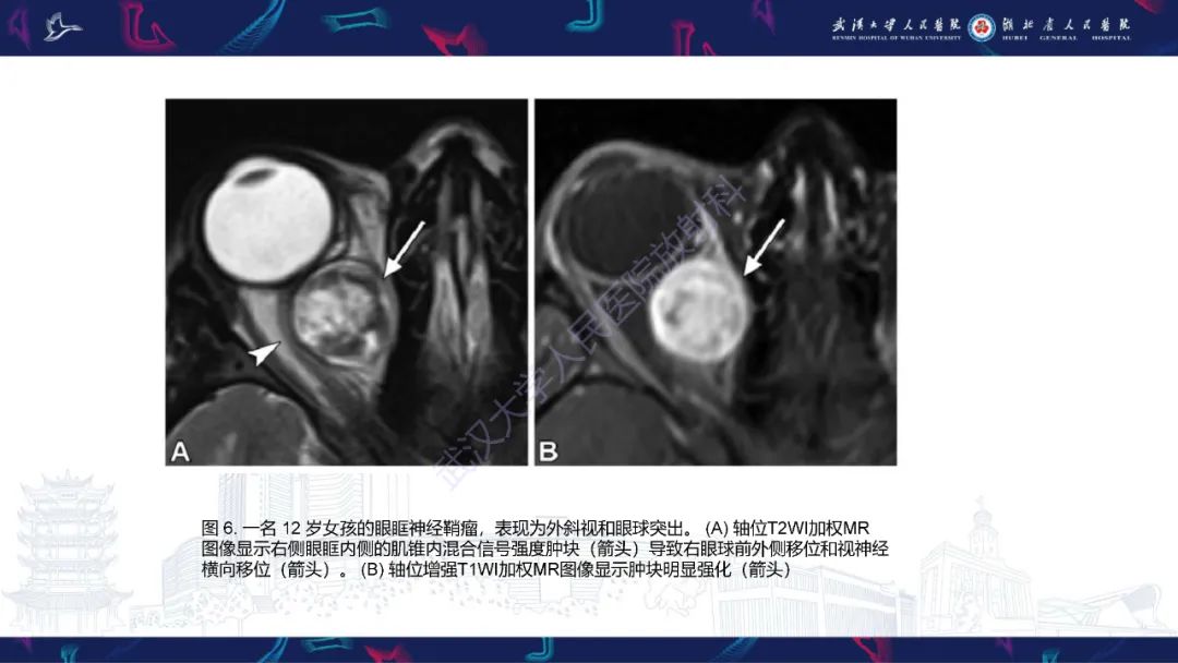影像PPT - 【PPT】儿童眼眶肿瘤及肿瘤样病变影像诊断-24