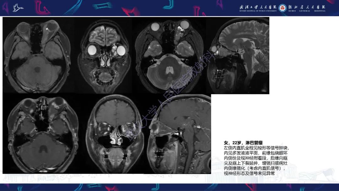 影像PPT - 【PPT】儿童眼眶肿瘤及肿瘤样病变影像诊断-22