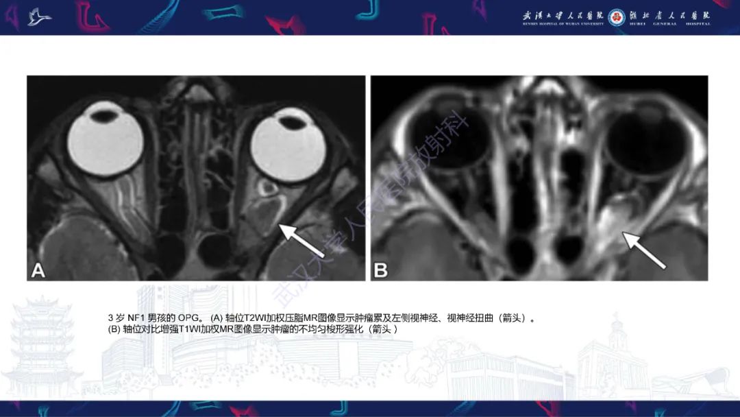 影像PPT - 【PPT】儿童眼眶肿瘤及肿瘤样病变影像诊断-28