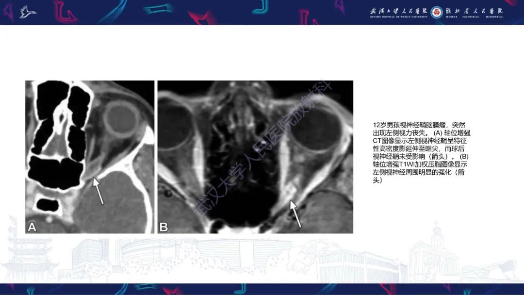 影像PPT - 【PPT】儿童眼眶肿瘤及肿瘤样病变影像诊断-26