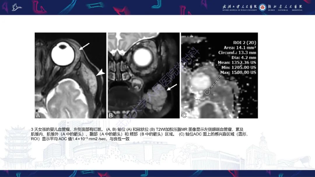 影像PPT - 【PPT】儿童眼眶肿瘤及肿瘤样病变影像诊断-31