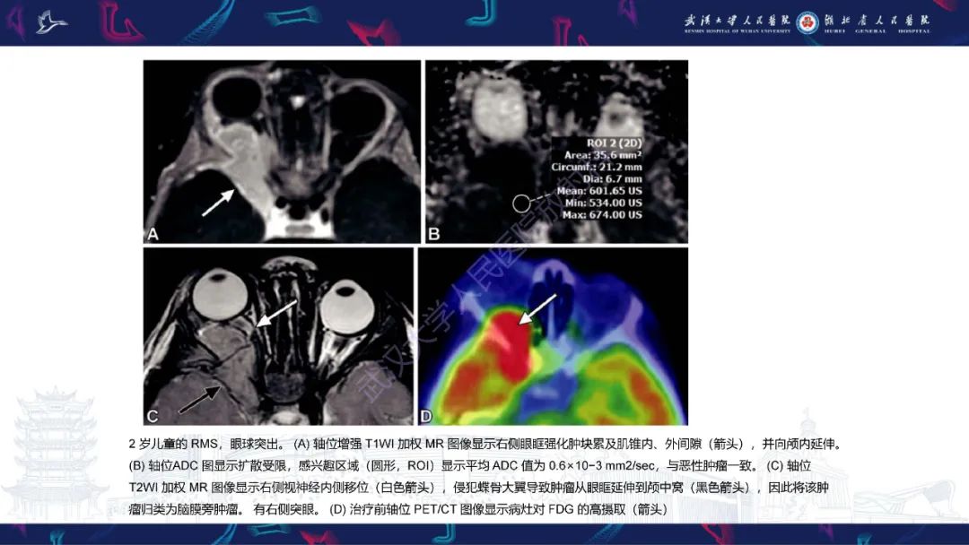 影像PPT - 【PPT】儿童眼眶肿瘤及肿瘤样病变影像诊断-35