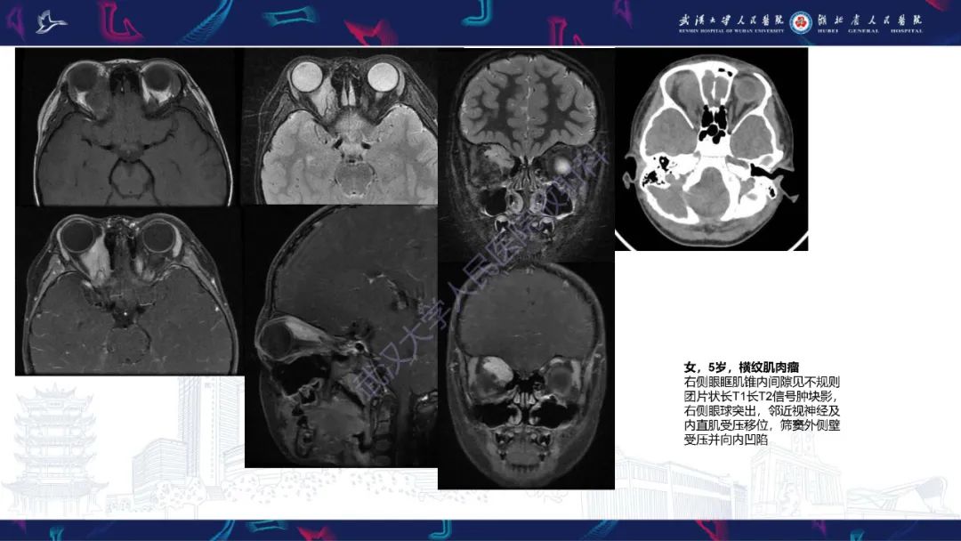 影像PPT - 【PPT】儿童眼眶肿瘤及肿瘤样病变影像诊断-36