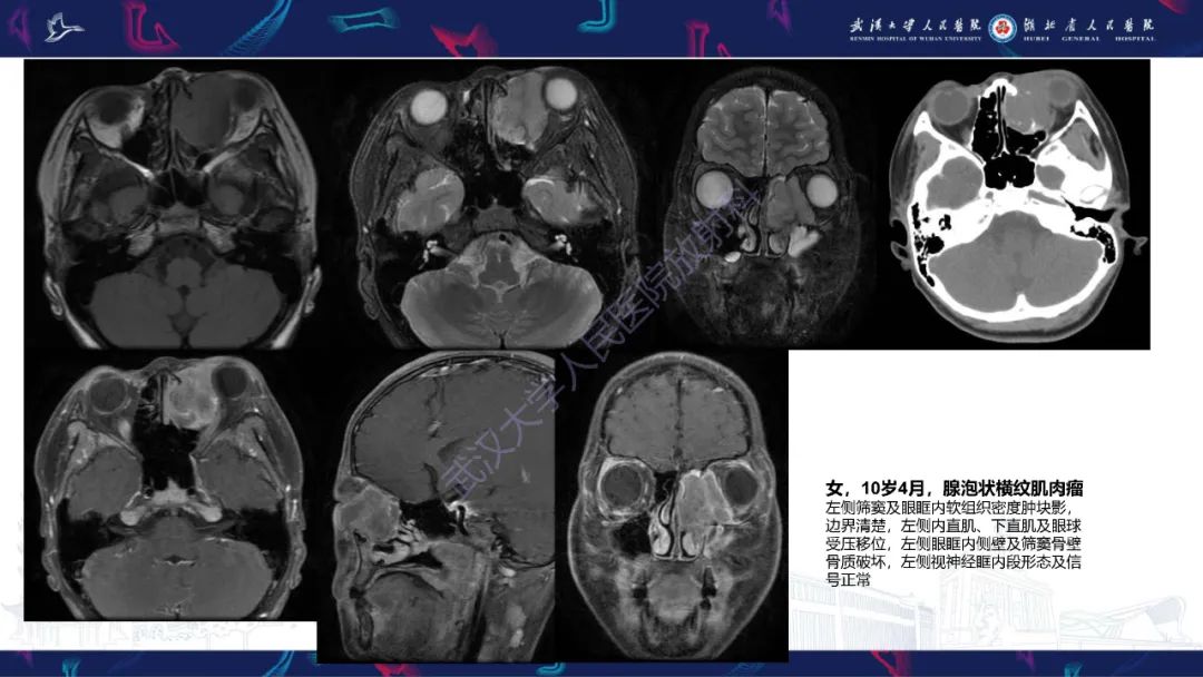 影像PPT - 【PPT】儿童眼眶肿瘤及肿瘤样病变影像诊断-37