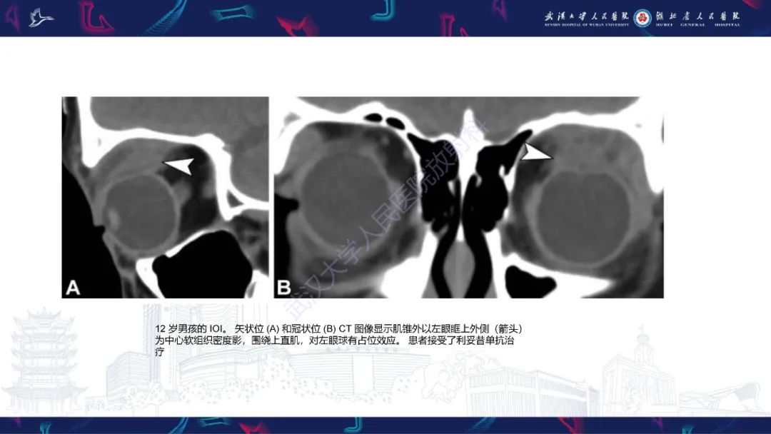 影像PPT - 【PPT】儿童眼眶肿瘤及肿瘤样病变影像诊断-40