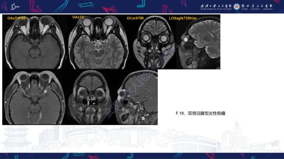 影像PPT - 【PPT】儿童眼眶肿瘤及肿瘤样病变影像诊断-41