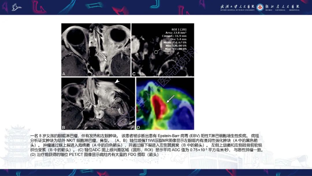 影像PPT - 【PPT】儿童眼眶肿瘤及肿瘤样病变影像诊断-43