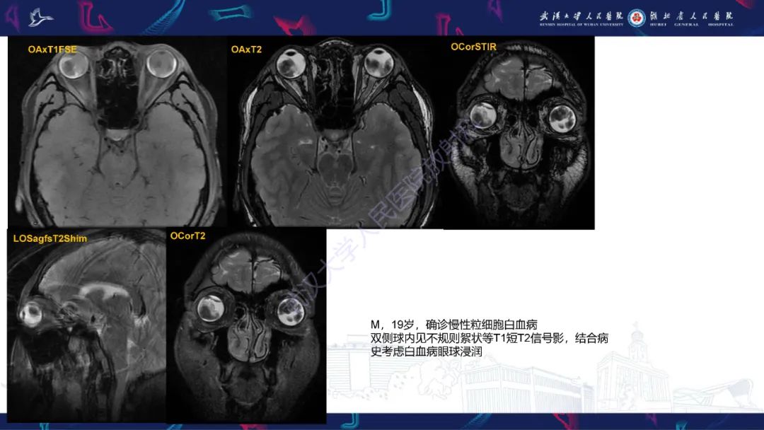 影像PPT - 【PPT】儿童眼眶肿瘤及肿瘤样病变影像诊断-44